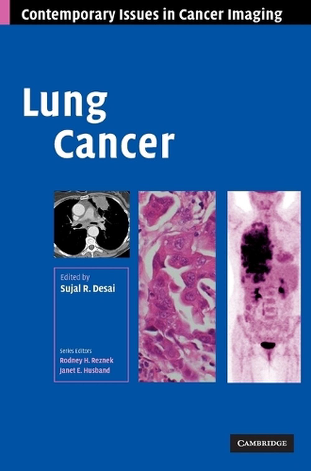 Lung Cancer by Sujal R. Desai (English) Hardcover Book Free Shipping ...