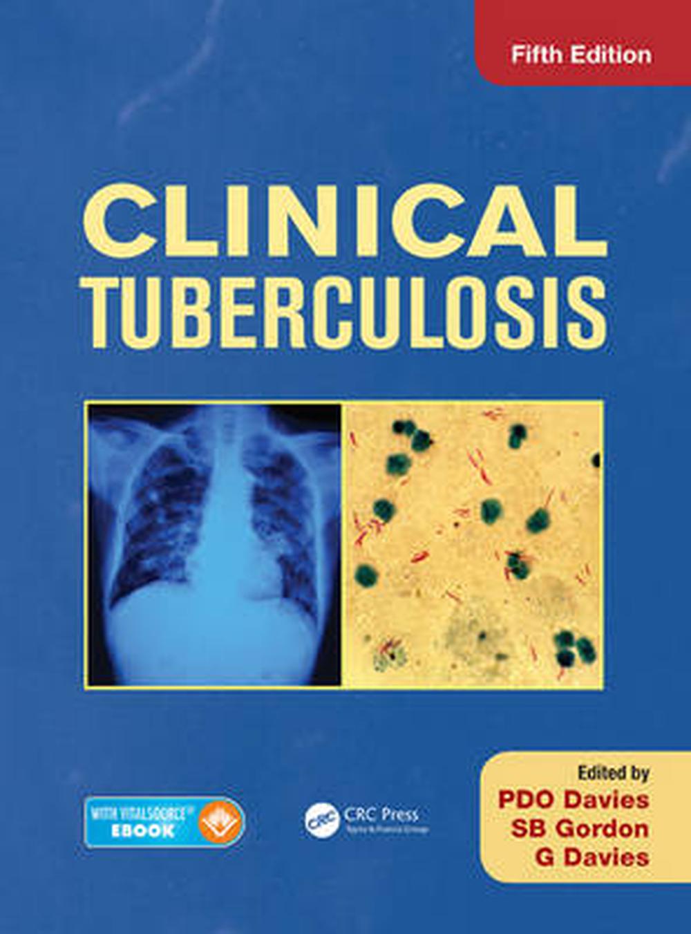 clinical case study tuberculosis