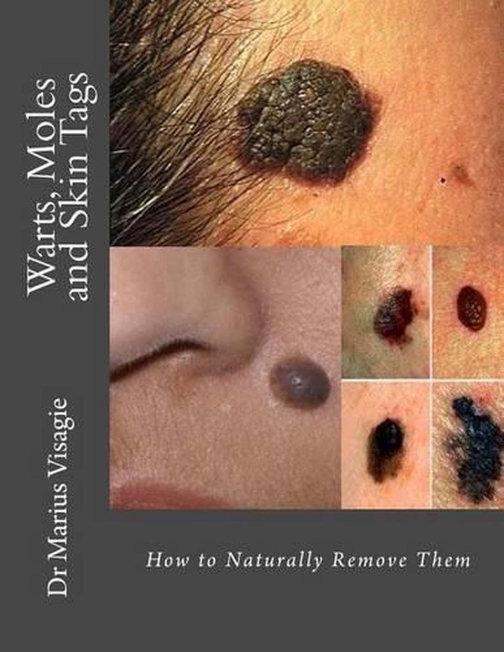 Warts, Moles and Skin Tags by Dr Marius Visagie (English) Free Shipping