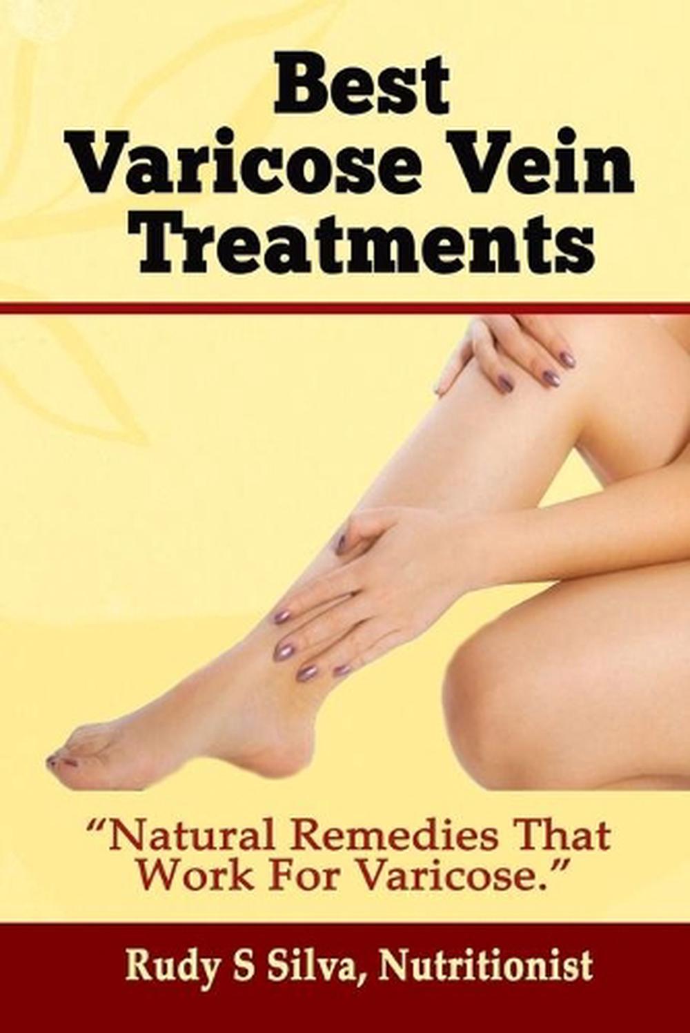 Best Varicose Vein Treatments Natural Remedies That Work for Varicose