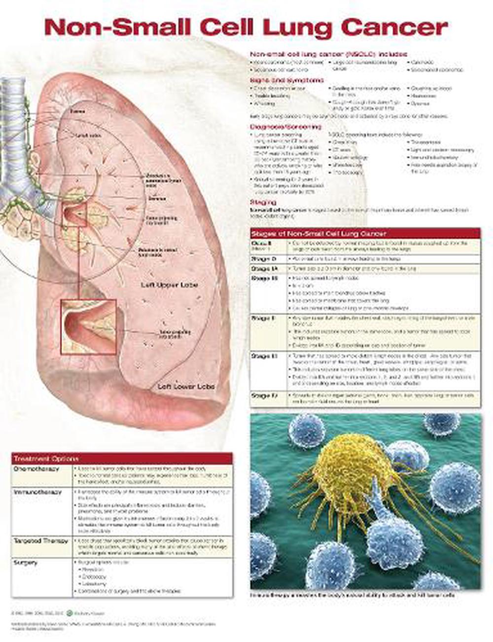 Non small cell lung cancer prognosis