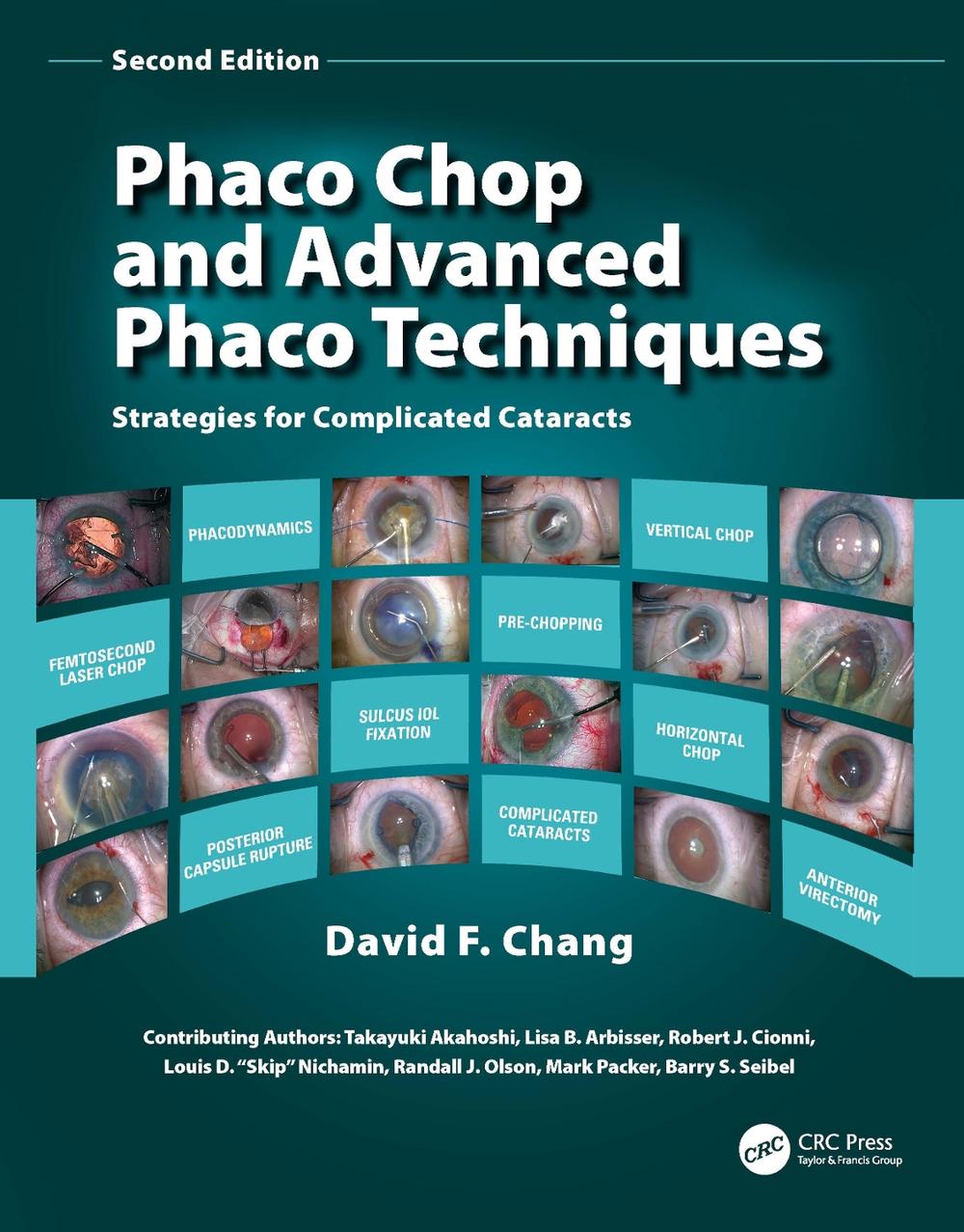 Phaco Chop and Advanced Phaco Techniques Strategies for Complicated