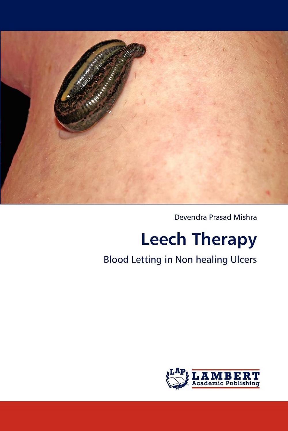 leech therapy